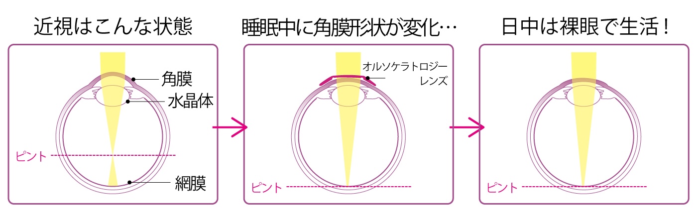 オルソケラトロジー